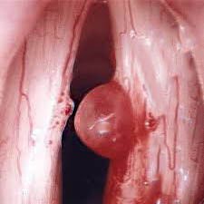 P&oacute;lipo de cuerda vocal