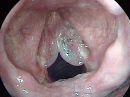 Edema de Reinke en cuerdas vocales