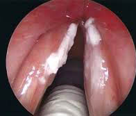 Leucoplasias en cuerdas vocales