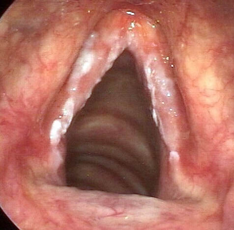Leucoplasias en cuerdas vocales