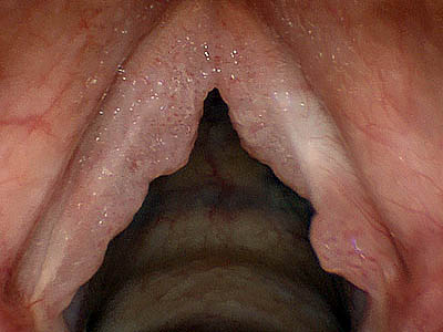 Leucoplasias en cuerdas vocales