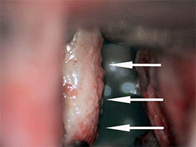Leucoplasias en cuerdas vocales