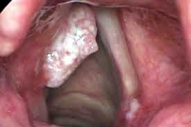 Neoplasias malignas en cuerda vocal