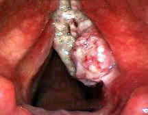 Neoplasias malignas en cuerda vocal