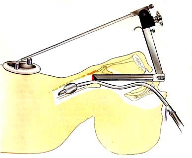 T&eacute;cnica de la Microcirug&iacute;a endolar&iacute;ngea