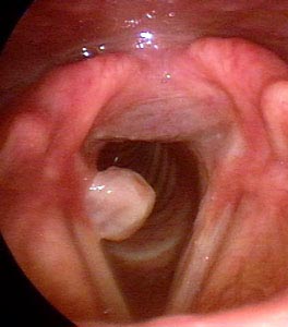 Granuloma en cuerda vocal