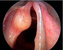 Quiste de cuerda vocal