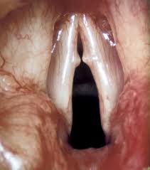 N&oacute;dulos bilaterales en cuerdas vocales