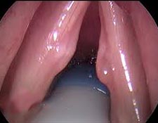 N&oacute;dulos bilaterales en cuerdas vocales