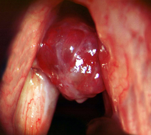 P&oacute;lipo de cuerda vocal