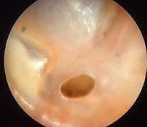 Perforaci&oacute;n timp&aacute;nica