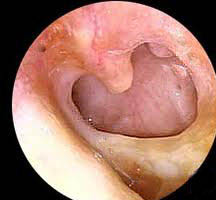 Perforaci&oacute;n timp&aacute;nica