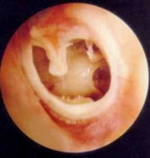 Perforaci&oacute;n timp&aacute;nica