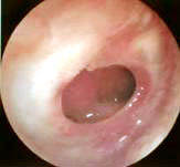 Perforaci&oacute;n timp&aacute;nica